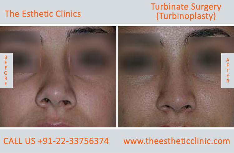 Turbinate Surgery, Turbinoplasty before after photos in mumbai india (1)